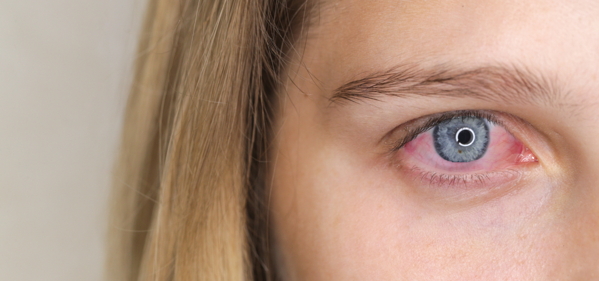 Olhos vermelhos e ardendo: causas e tratamento